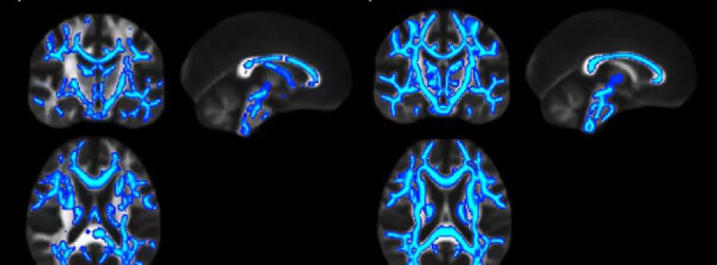 El daño cerebral inducido por el alcohol no cesa al dejar de beber